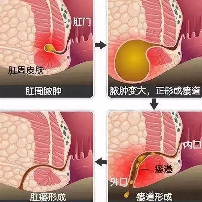 肛瘘最新治疗方法，隐藏在小巷中的特色小店治疗法