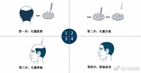 美国前沿植发技术解析,美国前沿植发技术解析——隐藏在巷弄深处的秘密植发小铺